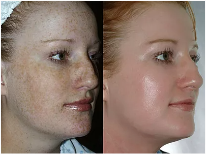 Chemical peels from a dermatologist