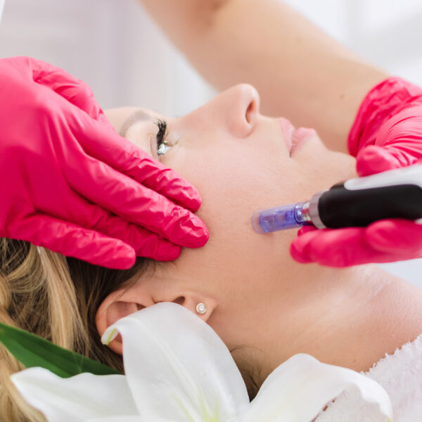 RF Microneedling